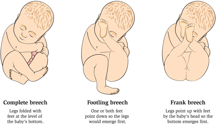 breech presentation at 14 weeks pregnant